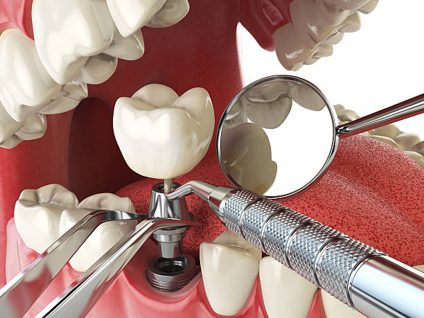 Emergency Dental Filling Replacement in TN